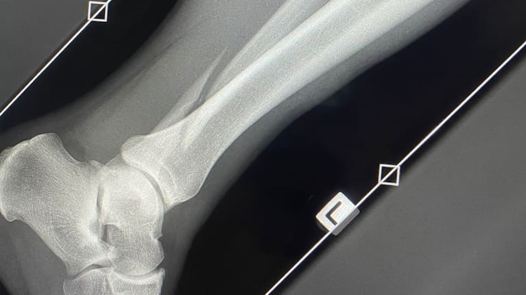 noah-hothams-x-ray-on-his-leg-injury-P4O32JDTJRB4ZBL2XLBHRIF4AE.jpg